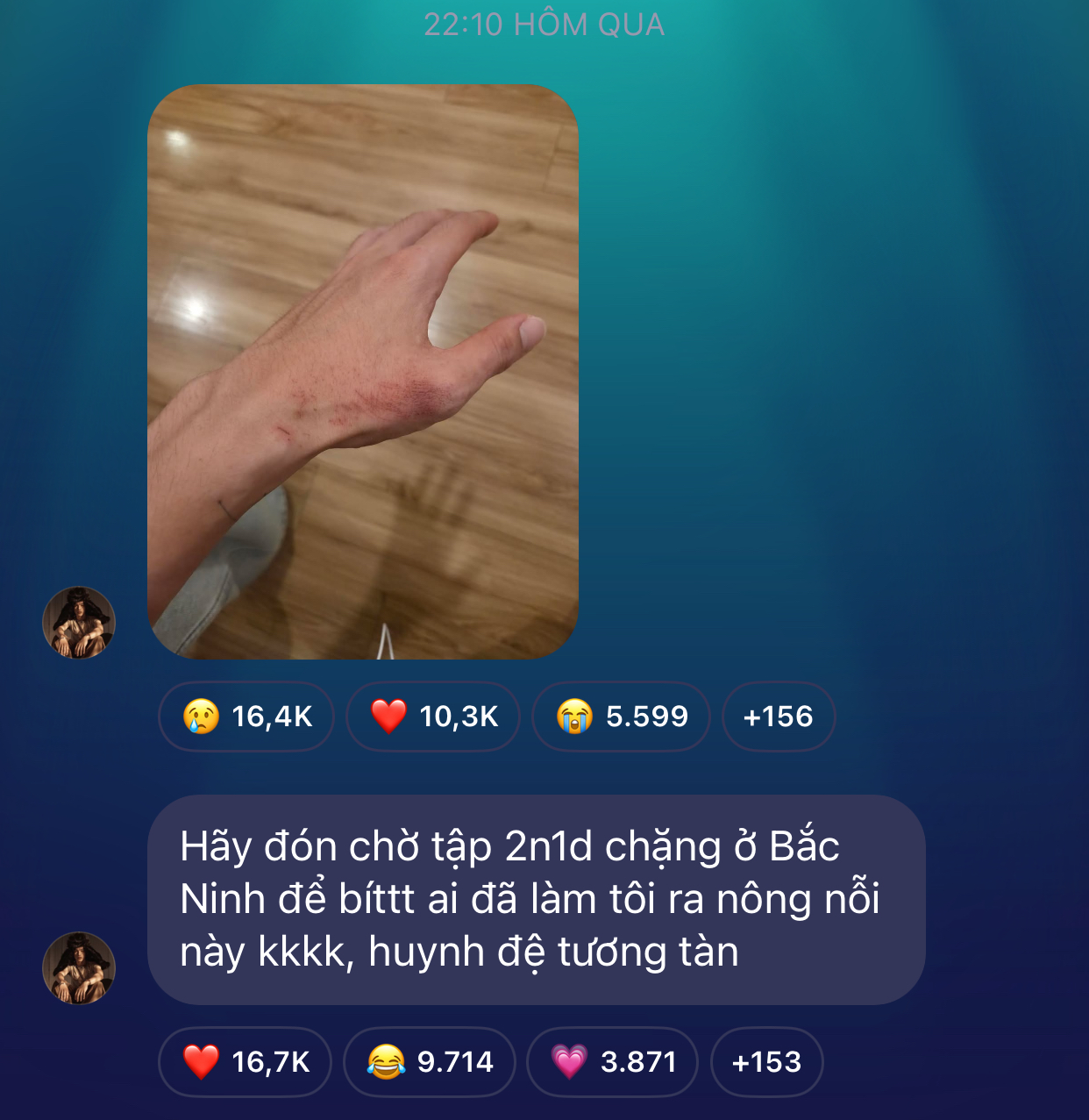 Hình ảnh bàn tay bị thương của HIEUTHUHAI